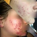 kerato-bordeaux-probleme-de-peau-vieillissement-de-la-peau-sur-visage-3-jeune-fille